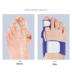 Correcteur d'orteil pour hallux valgus – Image 5